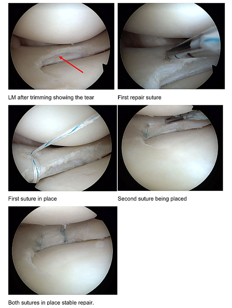 Arthroscopy images of meniscus tear and the repair procedures